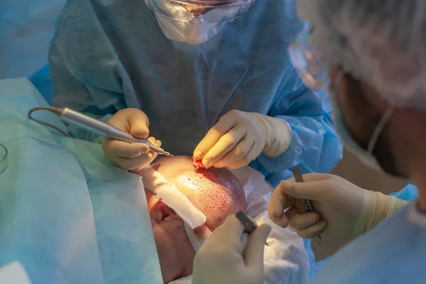 Baldness treatment. Hair transplant. Surgeons in the operating room carry out hair transplant surgery. Surgical technique that moves hair follicles from a part of the head.