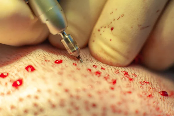 Patienten aus nächster Nähe. Glatzenbehandlung. Haartransplantation. Chirurgen im Operationssaal führen Haartransplantationen durch. Chirurgische Technik, die Haarfollikel aus einem Teil des Kopfes entfernt. — Stockfoto