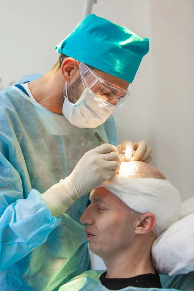 Pengobatan kebotakan. Transplantasi rambut. Ahli bedah di ruang operasi melakukan operasi transplantasi rambut. Teknik bedah yang menggerakkan folikel rambut dari bagian kepala . — Stok Foto