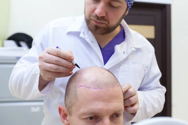 Baldness treatment. Patient suffering from hair loss in consultation with a doctor. Preparation for hair transplant surgery. The line marking the growth of hair. The patient controls the marking in