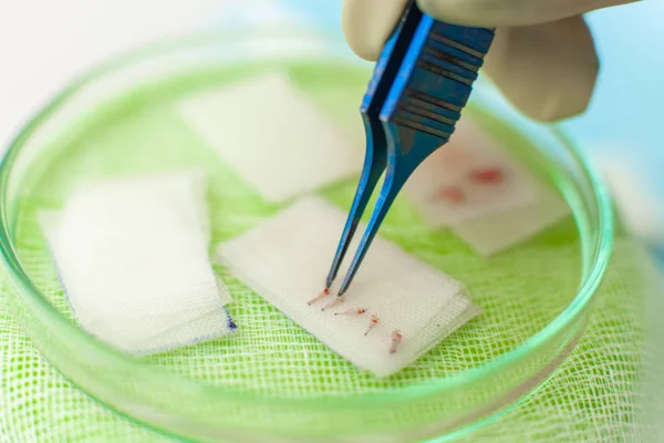 Hair follicles in the Cup close-up. Baldness treatment. Hair transplant. Surgeons in the operating room carry out hair transplant surgery. Surgical technique that moves hair follicles from a part of — Stock Photo, Image