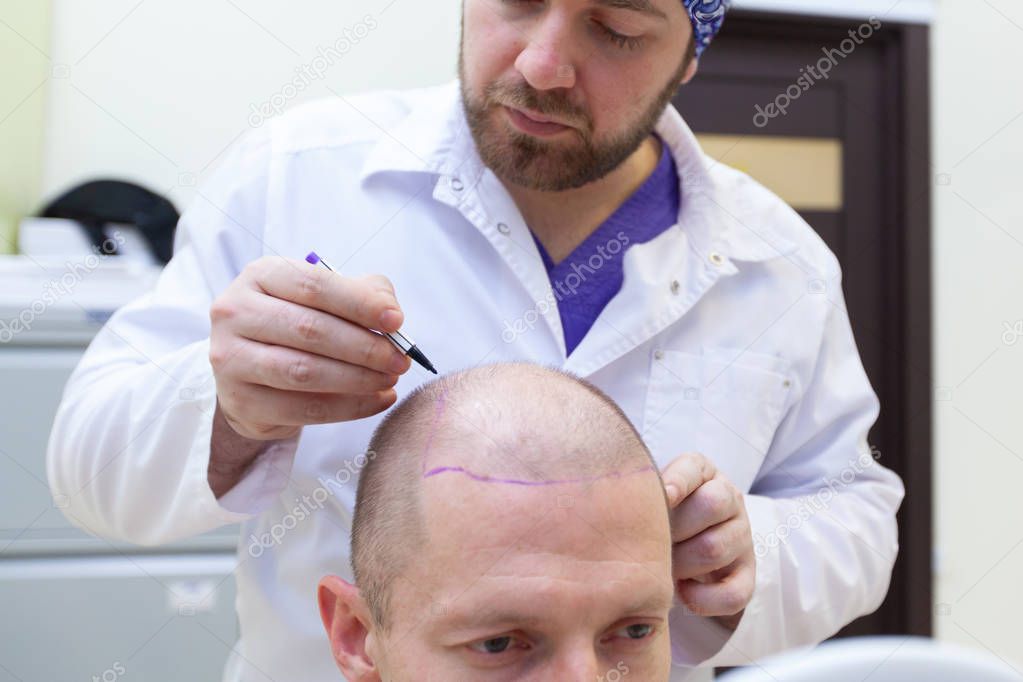 Baldness treatment. Patient suffering from hair loss in consultation with a doctor. Preparation for hair transplant surgery. The line marking the growth of hair. The patient controls the marking in