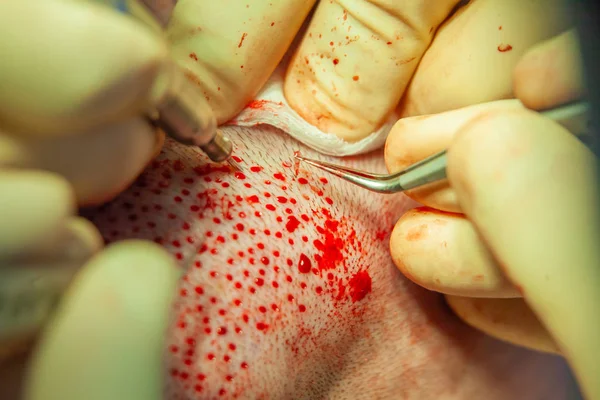 Patients head close-up. Baldness treatment. Hair transplant. Surgeons in the operating room carry out hair transplant surgery. Surgical technique that moves hair follicles from a part of the head. — Stock Photo, Image