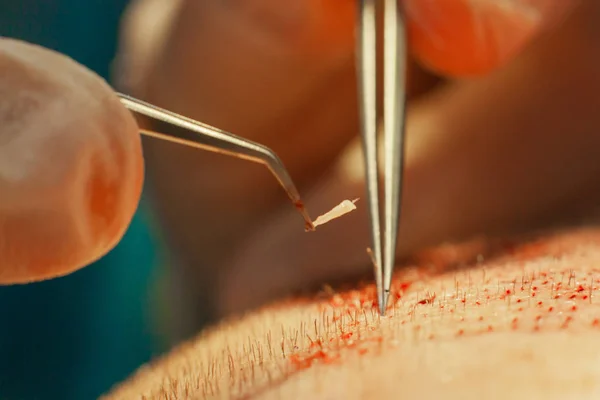 Macrophotography of a hair bulb transplanted into a hairless area. Baldness treatment. Hair transplant. Surgeons in the operating room carry out hair transplant surgery. Surgical technique that moves — Stock Photo, Image