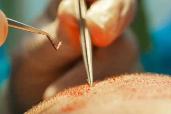 Macrophotography of a hair bulb transplanted into a hairless area. Baldness treatment. Hair transplant. Surgeons in the operating room carry out hair transplant surgery. Surgical technique that moves — Stock Photo, Image