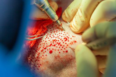 Hastalar yakın çekim. Kellik tedavisi. Saç ekimi. Ameliyathanedeki cerrahlar saç nakli ameliyatı gerçekleştirin. Saç köklerini başın bir kısmından hareket ettiren cerrahi teknik.