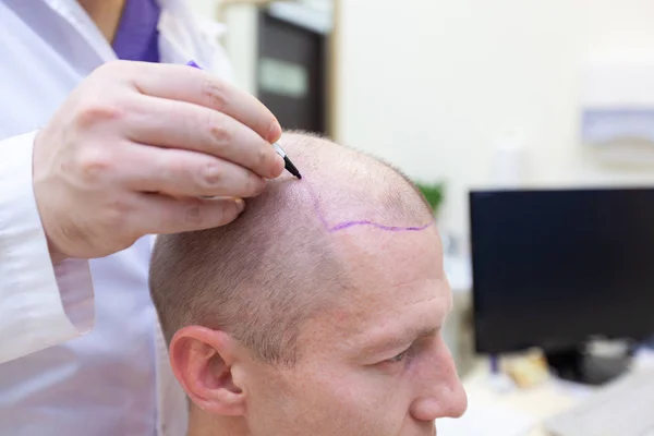 Tratamento da calvície. Paciente que sofre de perda de cabelo em consulta com um médico. Preparação para cirurgia de transplante de cabelo. A linha que marca o crescimento do cabelo. O paciente controla a marcação em — Fotografia de Stock