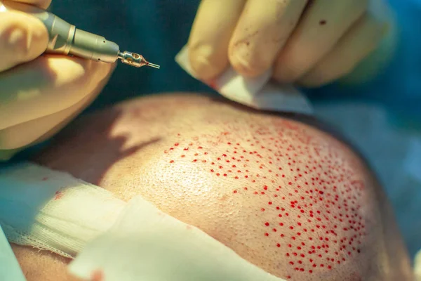 Patienten aus nächster Nähe. Glatzenbehandlung. Haartransplantation. Chirurgen im Operationssaal führen Haartransplantationen durch. Chirurgische Technik, die Haarfollikel aus einem Teil des Kopfes entfernt. — Stockfoto