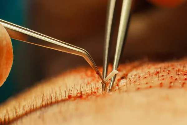 Macrophotography of a hair bulb transplanted into a hairless area. Baldness treatment. Hair transplant. Surgeons in the operating room carry out hair transplant surgery. Surgical technique that moves — Stock Photo, Image