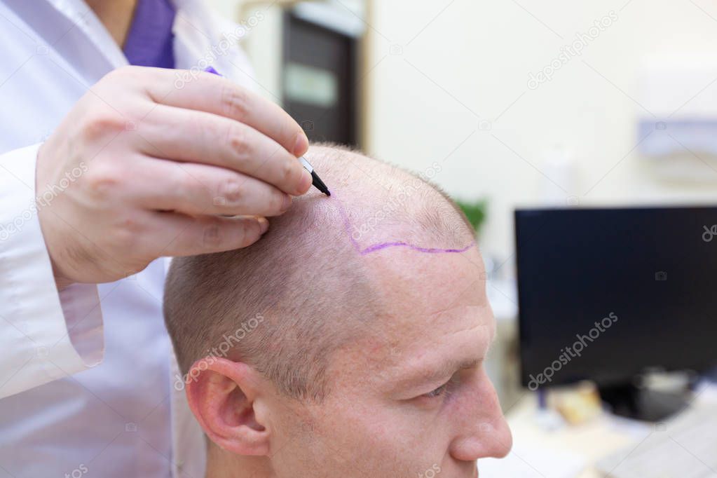 Baldness treatment. Patient suffering from hair loss in consultation with a doctor. Preparation for hair transplant surgery. The line marking the growth of hair. The patient controls the marking in
