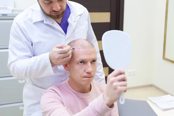 Leczenie łysienia. Pacjent cierpi na wypadanie włosów w porozumieniu z lekarzem. Przygotowanie do zabiegu transplantacji włosów. Linia oznaczania wzrostu włosów. Pacjent kontroluje oznakowanie w — Zdjęcie stockowe