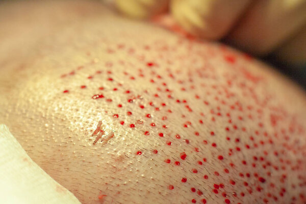 Patients head close-up. Baldness treatment. Hair transplant. Surgeons in the operating room carry out hair transplant surgery. Surgical technique that moves hair follicles from a part of the head.