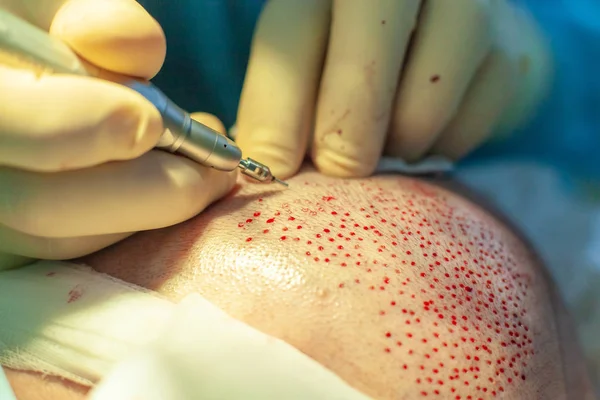 Hastalar yakın çekim. Kellik tedavisi. Saç ekimi. Ameliyathanedeki cerrahlar saç nakli ameliyatı gerçekleştirin. Saç köklerini başın bir kısmından hareket ettiren cerrahi teknik.