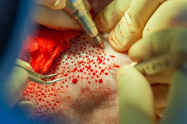 Patients head close-up. Baldness treatment. Hair transplant. Surgeons in the operating room carry out hair transplant surgery. Surgical technique that moves hair follicles from a part of the head. — Stock Photo, Image