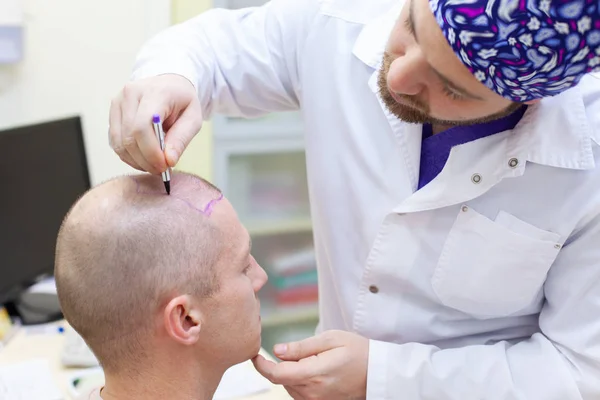 Baldness treatment. Patient suffering from hair loss in consultation with a doctor. Preparation for hair transplant surgery. The line marking the growth of hair. The patient controls the marking in — Stock Photo, Image