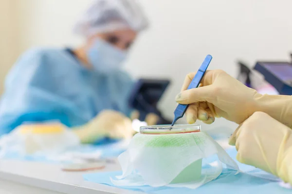 Läkaren under mikroskopet beräknar om hår säckarna. Skallighet behandling. Hår transplantation. Kirurgisk teknik som flyttar hår säckarna från en del av huvudet. — Stockfoto