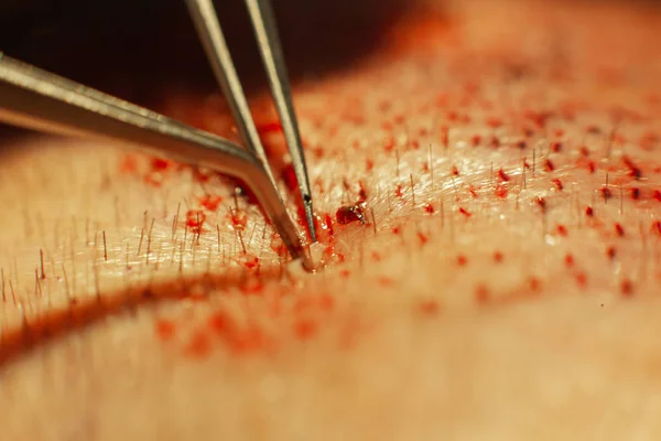 Macrophotography of a hair bulb transplanted into a hairless area. Baldness treatment. Hair transplant. Surgeons in the operating room carry out hair transplant surgery. Surgical technique that moves — Stock Photo, Image