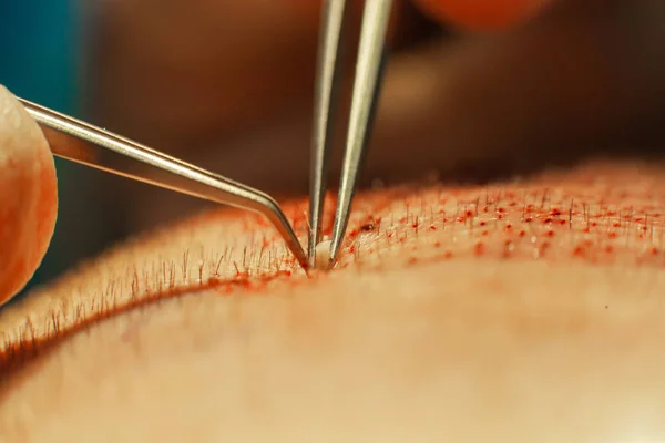 Macrophotography of a hair bulb transplanted into a hairless area. Baldness treatment. Hair transplant. Surgeons in the operating room carry out hair transplant surgery. Surgical technique that moves — Stock Photo, Image