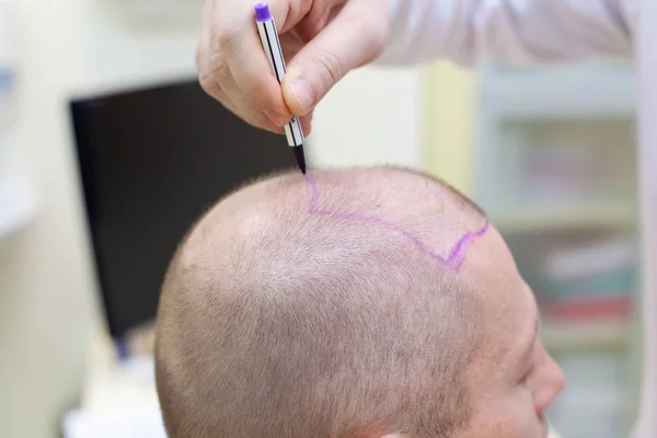 Tratamento da calvície. Paciente que sofre de perda de cabelo em consulta com um médico. Preparação para cirurgia de transplante de cabelo. A linha que marca o crescimento do cabelo. O paciente controla a marcação em — Fotografia de Stock