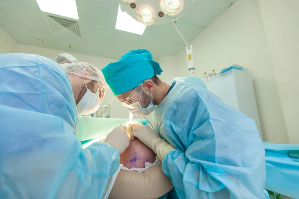 Baldness treatment. Hair transplant. Surgeons in the operating room carry out hair transplant surgery. Surgical technique that moves hair follicles from a part of the head. — Stock Photo, Image