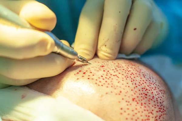 Les patients se rapprochent. Traitement de calvitie. Une greffe de cheveux. Les chirurgiens dans la salle d'opération effectuent une greffe de cheveux. Technique chirurgicale qui déplace les follicules pileux d'une partie de la tête . — Photo