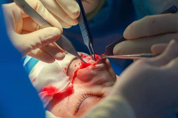 Cirurgião e seu assistente realizando cirurgia estética no nariz na sala de cirurgia do hospital. Reformulação do nariz, aumento. Rinoplastia . — Fotografia de Stock