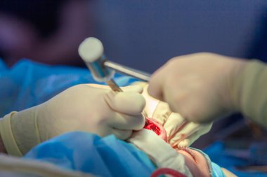 Cerrah ve asistanı hastane ameliyathanede burun üzerinde kozmetik cerrahi gerçekleştiriyor. Burun yeniden şekillendirme, augmentasyon. Rinoplasti. Çekiç.