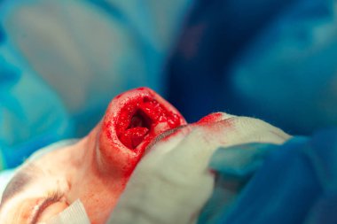 Cerrah ve hastane ameliyathane burnuna estetik ameliyat asistanı. Burnun yeniden şekillendirilmesi, büyütme. Burun estetiği.