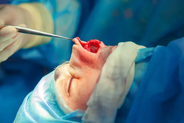 Surgeon and his assistant performing cosmetic surgery on nose in hospital operating room. Nose reshaping, augmentation. Rhinoplasty. — Stock Photo, Image