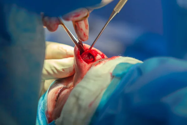 Хірург і його асистент виконують косметичну хірургію на носі в операційній кімнаті лікарні. Перетворення носа, розширення. ринопластики . — стокове фото