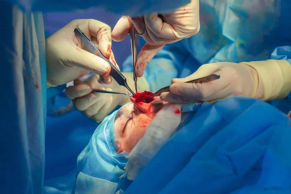 Cirujano y su asistente realizando cirugía estética en la nariz en el quirófano del hospital. Remodelación de la nariz, aumento. Rinoplastia . — Foto de Stock