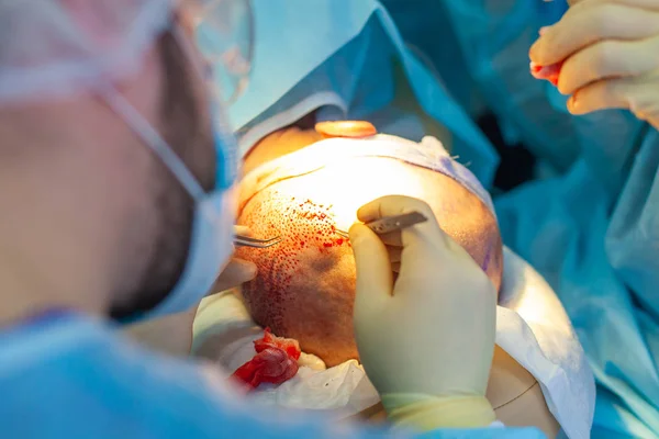 Patienten aus nächster Nähe. Glatzenbehandlung. Haartransplantation. Chirurgen im Operationssaal führen Haartransplantationen durch. Chirurgische Technik, die Haarfollikel aus einem Teil des Kopfes entfernt. — Stockfoto