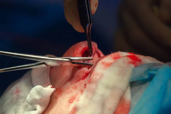 Surgeon and his assistant performing cosmetic surgery on nose in hospital operating room. Nose reshaping, augmentation. Rhinoplasty. — Stock Photo, Image