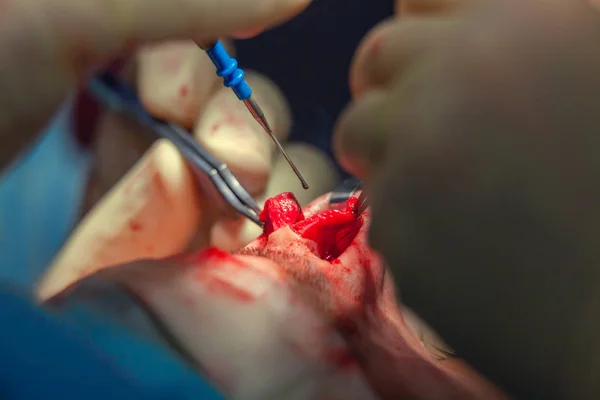 Surgeon and his assistant performing cosmetic surgery on nose in hospital operating room. Nose reshaping, augmentation. Rhinoplasty. — Stock Photo, Image