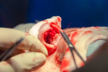 Cerrah ve hastane ameliyathane burnuna estetik ameliyat asistanı. Burnun yeniden şekillendirilmesi, büyütme. Burun estetiği.