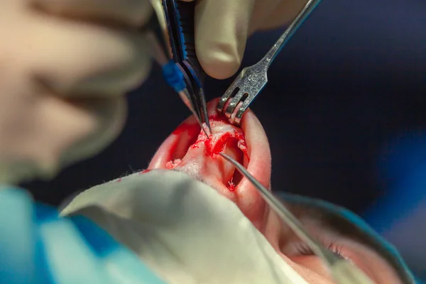 Chirurg i jego asystent, wykonywanie operacji plastycznej na nos w sali operacyjnej szpitala. Nos, przekształcanie, powiększania. Korekcja nosa. — Zdjęcie stockowe