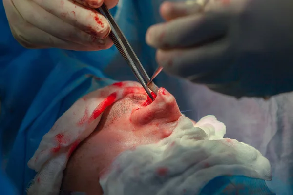 Хірург і його асистент виконують косметичну хірургію на носі в операційній кімнаті лікарні. Перетворення носа, розширення. ринопластики . — стокове фото