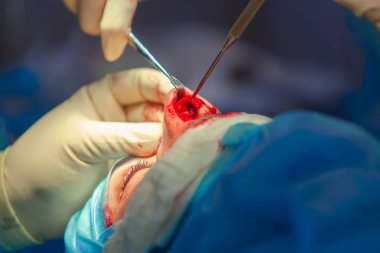 Cerrah ve hastane ameliyathane burnuna estetik ameliyat asistanı. Burnun yeniden şekillendirilmesi, büyütme. Burun estetiği.