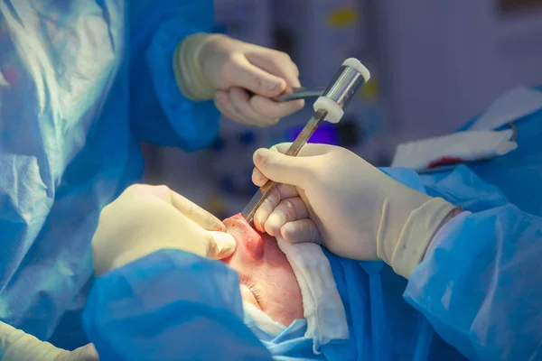 Cirujano y su asistente realizando cirugía estética en la nariz en el quirófano del hospital. Remodelación de la nariz, aumento. Rinoplastia. Martillo . — Foto de Stock