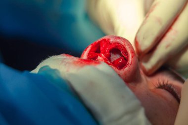 Cerrah ve hastane ameliyathane burnuna estetik ameliyat asistanı. Burnun yeniden şekillendirilmesi, büyütme. Burun estetiği.