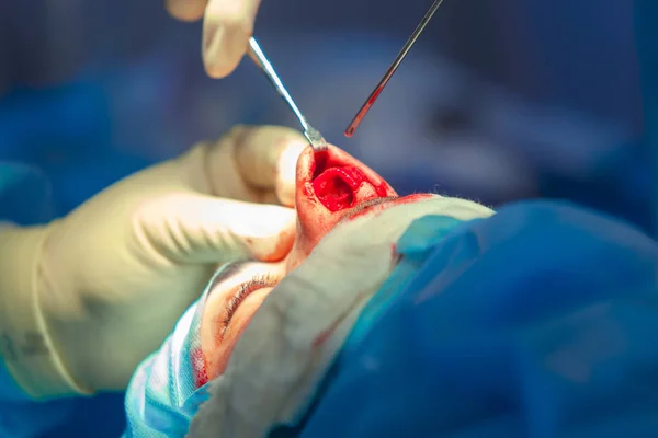 Cirurgião e seu assistente realizando cirurgia estética no nariz na sala de cirurgia do hospital. Reformulação do nariz, aumento. Rinoplastia . — Fotografia de Stock