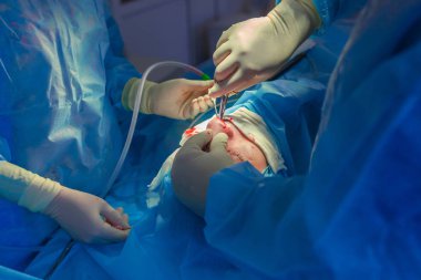 Cerrah ve hastane ameliyathane burnuna estetik ameliyat asistanı. Burnun yeniden şekillendirilmesi, büyütme. Burun estetiği.