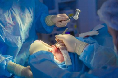 Cerrah ve asistanı hastane ameliyathanede burun üzerinde kozmetik cerrahi gerçekleştiriyor. Burun yeniden şekillendirme, augmentasyon. Rinoplasti. Çekiç.