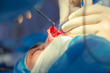 Cerrah ve hastane ameliyathane burnuna estetik ameliyat asistanı. Burnun yeniden şekillendirilmesi, büyütme. Burun estetiği.