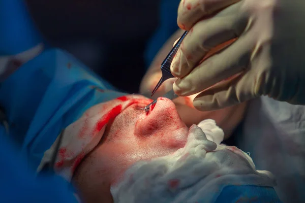外科医と彼のアシスタントは、病院の手術室で鼻の整形手術を実行します。鼻の整形、豊胸。鼻形成術. — ストック写真