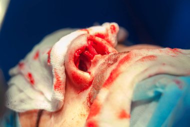 Cerrah ve hastane ameliyathane burnuna estetik ameliyat asistanı. Burnun yeniden şekillendirilmesi, büyütme. Burun estetiği.