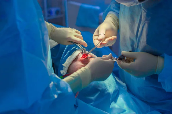 Chirurg und sein Assistent bei Schönheitsoperationen an der Nase im Operationssaal des Krankenhauses. Nasenumformung, Augmentation. Nasenkorrektur. — Stockfoto