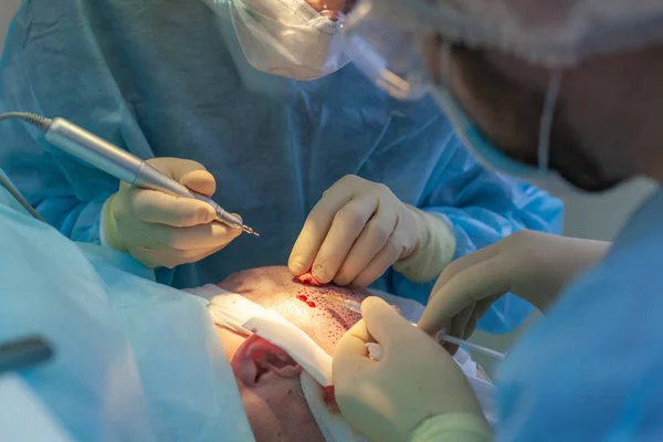 Skallighet behandling. Hårtransplantation. Kirurger i operationssalen utför hår transplantationskirurgi. Kirurgisk teknik som flyttar hårsäckarna från en del av huvudet. — Stockfoto