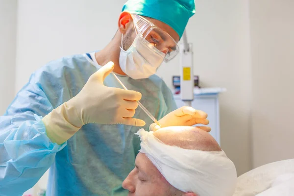 O cirurgião dá injeções na cabeça. Tratamento da calvície. Transplante de cabelo. Cirurgiões na sala de cirurgia realizar cirurgia de transplante de cabelo. Técnica cirúrgica que move os folículos pilosos de um — Fotografia de Stock