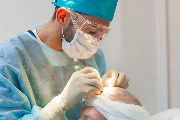 Leczenie łysienia. Przeszczep włosów. Chirurdzy w sali operacyjnej przeprowadzają operację przeszczepu włosów. Technika chirurgiczna, która przenosi mieszki włosowe z części głowy. — Zdjęcie stockowe